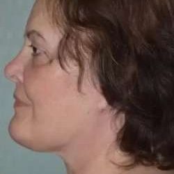 Face Neck Lift Before & After Patient #173