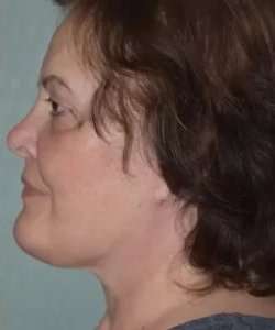 Face Neck Lift Before & After Patient #173
