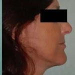 Face Neck Lift Before & After Patient #176