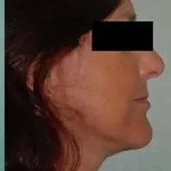 Face Neck Lift Before & After Patient #176