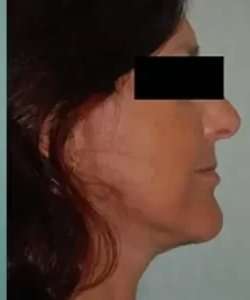 Face Neck Lift Before & After Patient #176