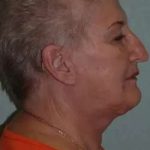 Face Neck Lift Before & After Patient #179