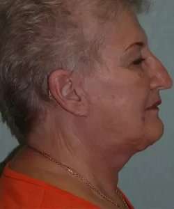Face Neck Lift Before & After Patient #179