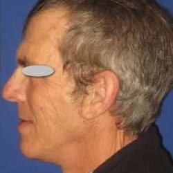 Face Neck Lift Before & After Patient #182