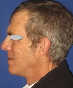 Face Neck Lift Before & After Patient #182