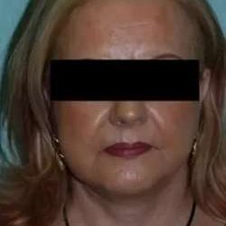 Face Neck Lift Before & After Patient #185