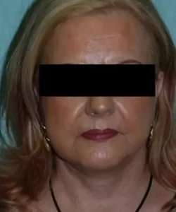 Face Neck Lift Before & After Patient #185