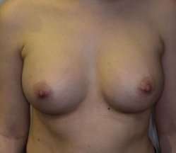 Breast Augmentation Before & After Patient #191