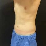 Coolsculpting Before & After Patient #251