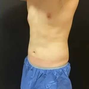 Coolsculpting Before & After Patient #251