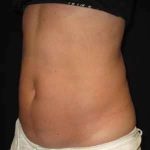 Coolsculpting Before & After Patient #254