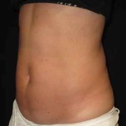 Coolsculpting Before & After Patient #254