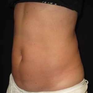 Coolsculpting Before & After Patient #254