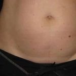 Coolsculpting Before & After Patient #259