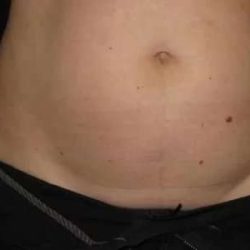 Coolsculpting Before & After Patient #259