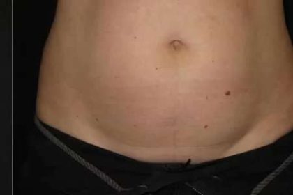 Coolsculpting Before & After Patient #259