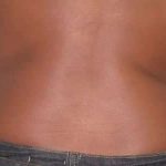 Coolsculpting Before & After Patient #262