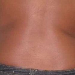 Coolsculpting Before & After Patient #262