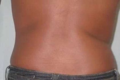 Coolsculpting Before & After Patient #262