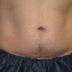 Coolsculpting Before & After Patient #265