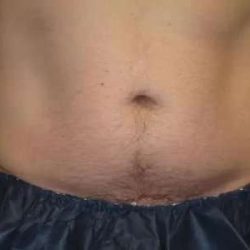 Coolsculpting Before & After Patient #265