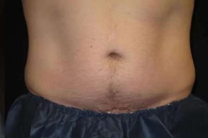 Coolsculpting Before & After Patient #265