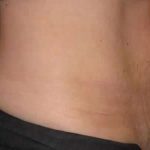 Coolsculpting Before & After Patient #268