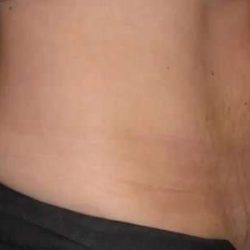Coolsculpting Before & After Patient #268