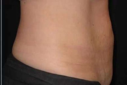 Coolsculpting Before & After Patient #268
