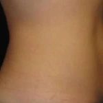 Coolsculpting Before & After Patient #271