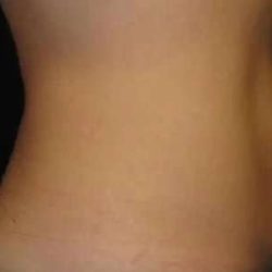 Coolsculpting Before & After Patient #271