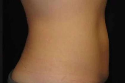 Coolsculpting Before & After Patient #271