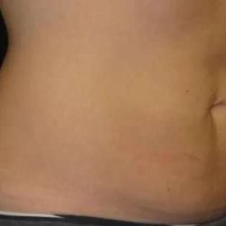 Coolsculpting Before & After Patient #274
