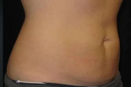 Coolsculpting Before & After Patient #274