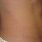Coolsculpting Before & After Patient #277
