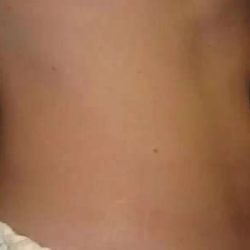Coolsculpting Before & After Patient #277