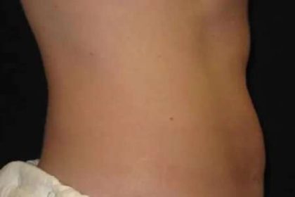 Coolsculpting Before & After Patient #277