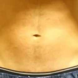Coolsculpting Before & After Patient #280