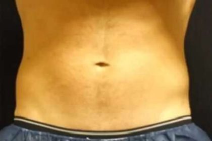 Coolsculpting Before & After Patient #280