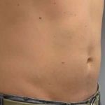 Coolsculpting Before & After Patient #283