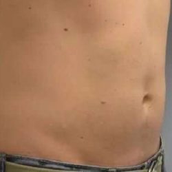 Coolsculpting Before & After Patient #283