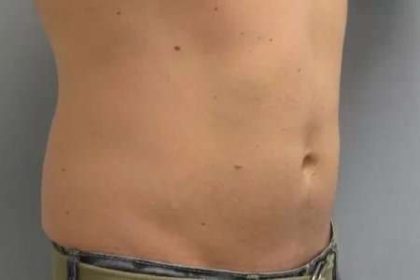 Coolsculpting Before & After Patient #283
