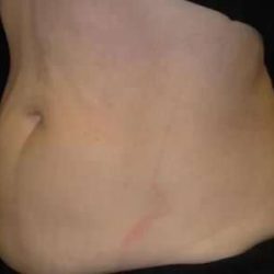 Coolsculpting Before & After Patient #288