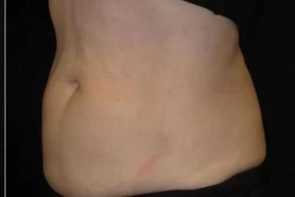 Coolsculpting Before & After Patient #288