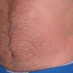 Coolsculpting Before & After Patient #291