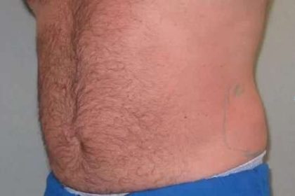 Coolsculpting Before & After Patient #291