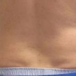 Coolsculpting Before & After Patient #296