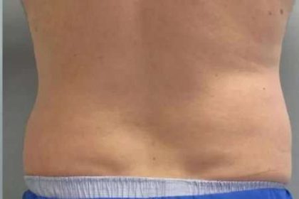 Coolsculpting Before & After Patient #296
