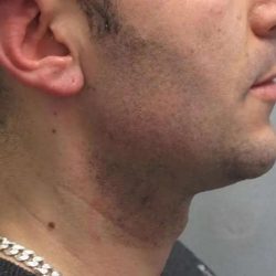 Ultherapy Before & After Patient #303