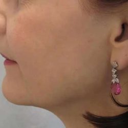 Ultherapy Before & After Patient #306